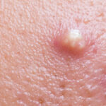 Skin Cancer Pictures Early Stages
